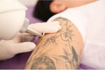 Tattoo removal,Skin Rejuvenation and Scalp Micropigmentation