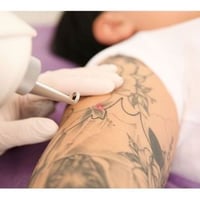 Tattoo removal,Skin Rejuvenation and Scalp Micropigmentation image