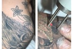 Premium Tattoo Removal & Skin Rejuvenation Laser