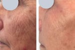 Premium Tattoo Removal & Skin Rejuvenation Clinic in Lane Cove, NSW