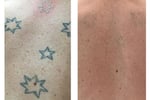 Premium Tattoo Removal & Skin Rejuvenation Clinic in Lane Cove, NSW