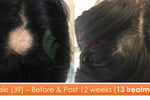 Exciting Business Opportunity in the Hair Loss Treatment Industry - Sydney, NSW