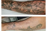 Premium Tattoo Removal & Skin Rejuvenation Laser