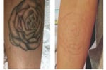 Premium Tattoo Removal & Skin Rejuvenation Laser