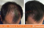 Exciting Business Opportunity in the Hair Loss Treatment Industry - Sydney, NSW