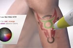 Premium Tattoo Removal & Skin Rejuvenation Clinic in Lane Cove, NSW