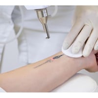 Laser Tattoo Removal Clinic - Prime Rosanna Location Low Overheads & High Margins image