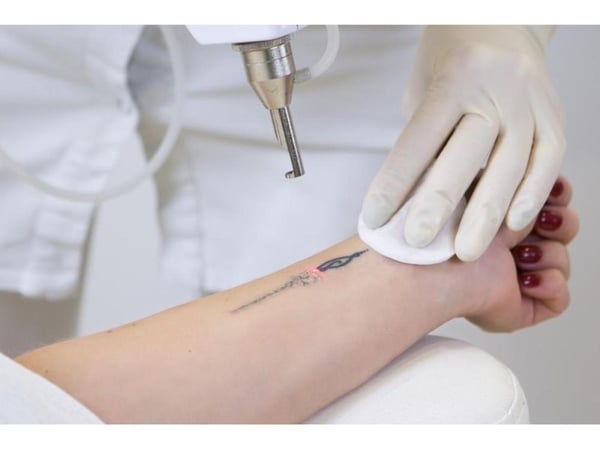 Laser Tattoo Removal Clinic - Prime Rosanna Location Low Overheads & High Margins