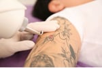 Tattoo removal, Skin Rejuvenation and Scalp Micropigmentation