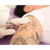 Tattoo removal, Skin Rejuvenation and Scalp Micropigmentation image