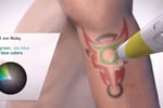 Premium Tattoo Removal & Skin Rejuvenation Clinic in Lane Cove, NSW