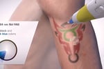 Premium Tattoo Removal & Skin Rejuvenation Clinic in Lane Cove, NSW