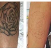 Premium Tattoo Removal & Skin Rejuvenation Clinic in Lane Cove, NSW image