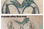 Premium Tattoo Removal & Skin Rejuvenation Laser