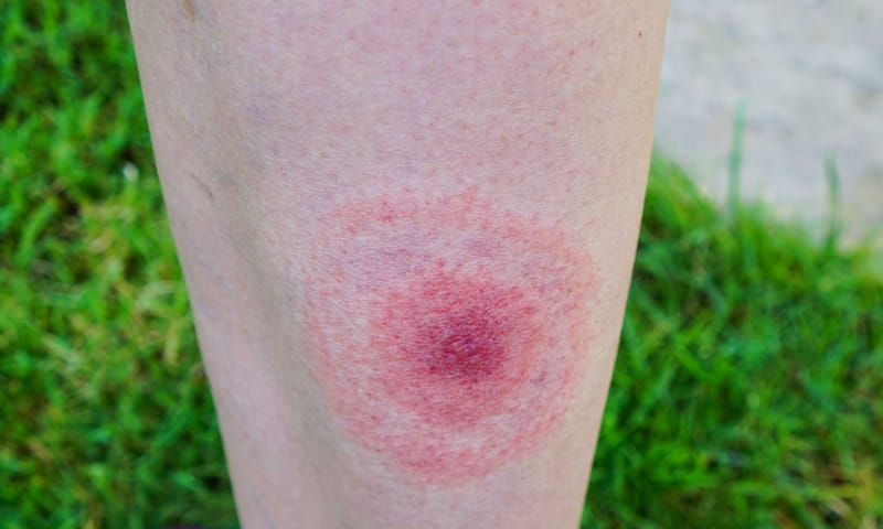 Rode kring na tegenbeet Rode kring na tegenbeet