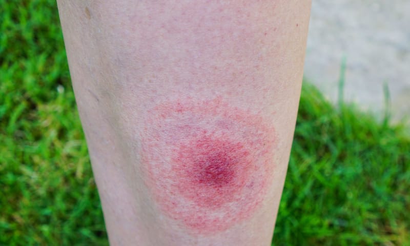 Rode kring na tegenbeet Rode kring na tegenbeet