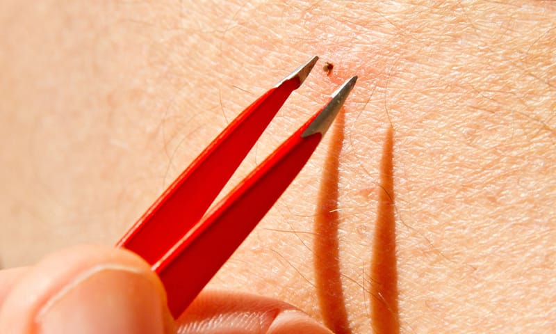 Teek verwijderen met pincet