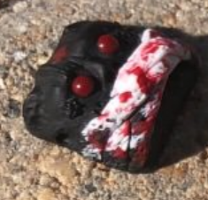 GI BLeed