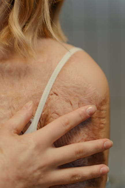 Detailed close-up view of burn scars on human shoulder, highlighting skin texture and scar healing process.