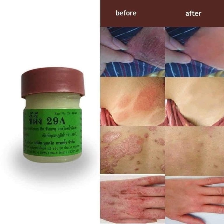 Thuốc mỡ A29 đặc trị: chàm - ghẻ nước - nấm - hắc lào - lang ben