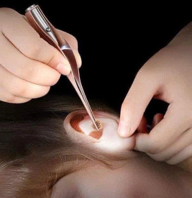 BỘ SOI TAI VÀ DỤNG CỤ GẮP CÓ ĐÈN