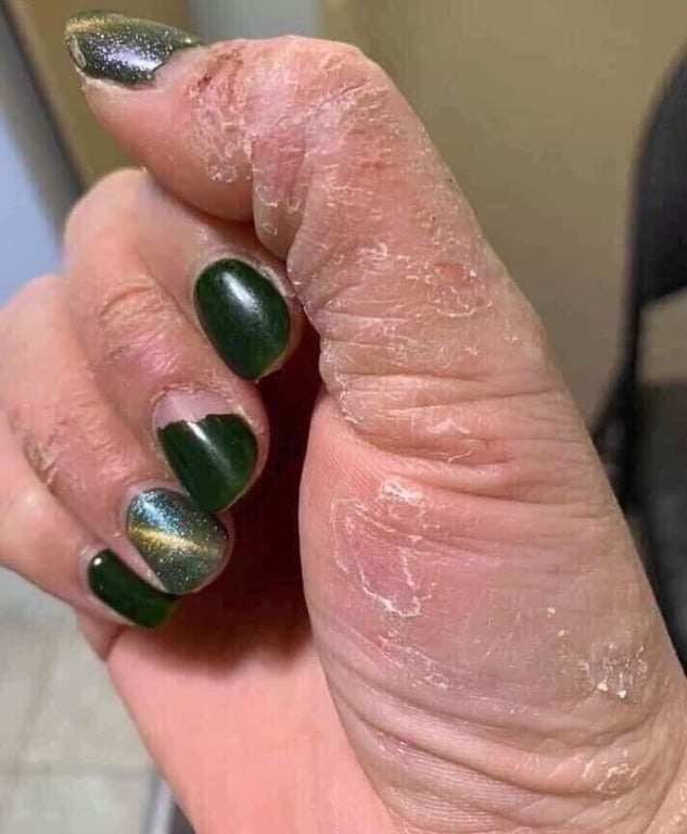 KEM BÔI DA TRỊ VẢY NẾN, NGỨA, VIÊM DA CLINODERM THÁI LAN Tuýp 15gram