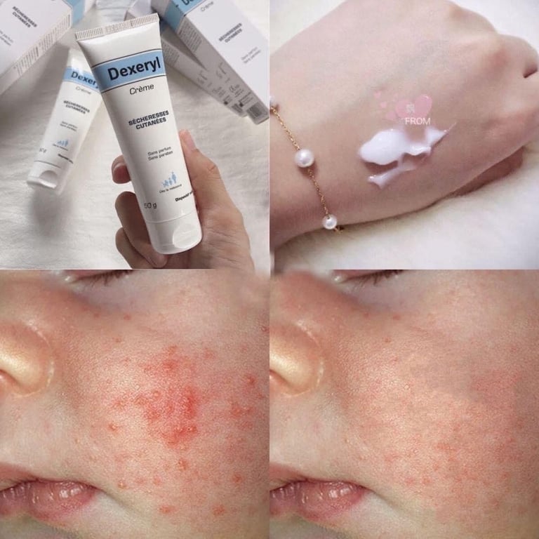 𝐊𝐄𝐌 𝐍𝐄̉ 𝐃𝐄𝐗𝐄𝐑𝐘𝐋 𝐏𝐇𝐀́𝐏