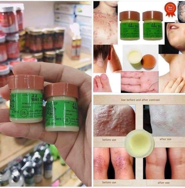 Thuốc mỡ A29 đặc trị: chàm - ghẻ nước - nấm - hắc lào - lang ben