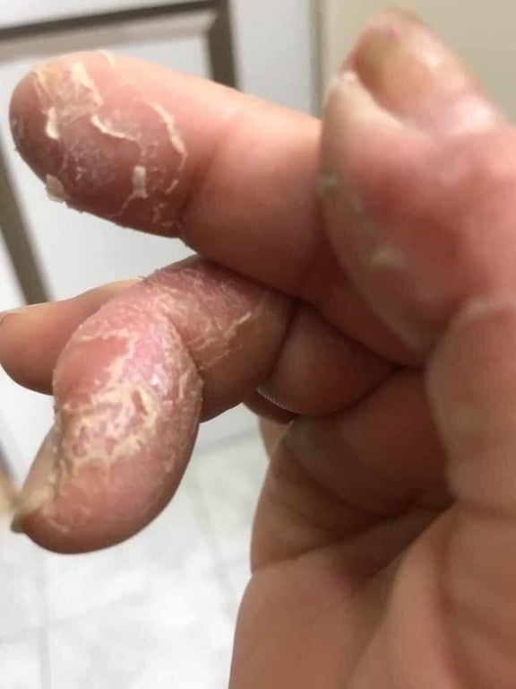 KEM BÔI DA TRỊ VẢY NẾN, NGỨA, VIÊM DA CLINODERM THÁI LAN Tuýp 15gram