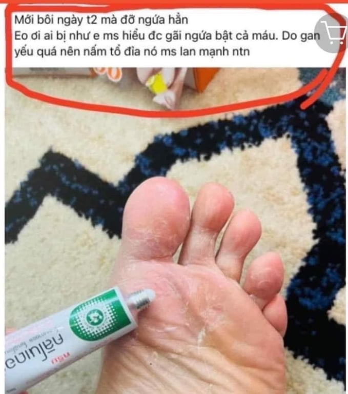 KEM BÔI DA TRỊ VẢY NẾN, NGỨA, VIÊM DA CLINODERM THÁI LAN Tuýp 15gram