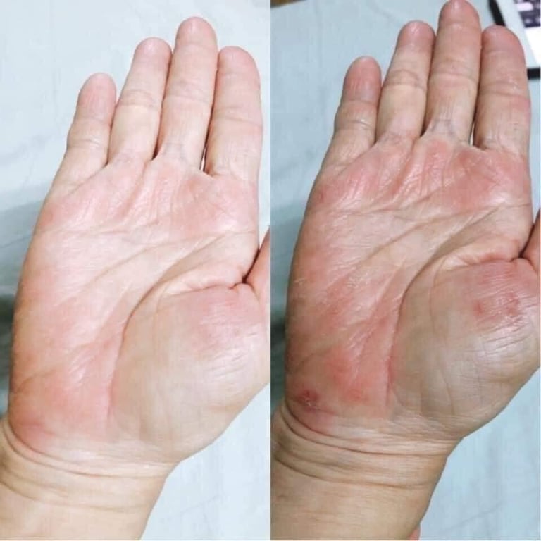 KEM BÔI DA TRỊ VẢY NẾN, NGỨA, VIÊM DA CLINODERM THÁI LAN Tuýp 15gram