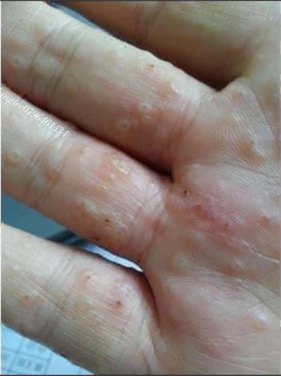 Thuốc mỡ A29 đặc trị: chàm - ghẻ nước - nấm - hắc lào - lang ben