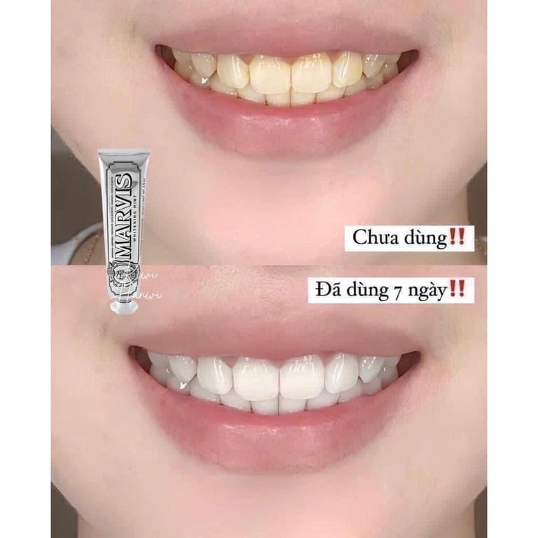 KEM ĐÁNH RĂNG QUÝ TỘC #MAVIS