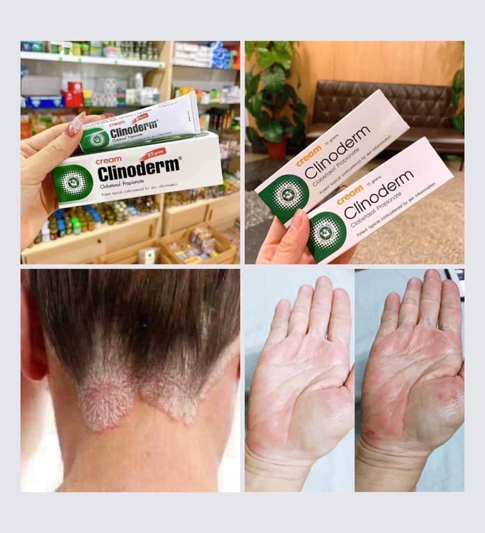 KEM BÔI DA TRỊ VẢY NẾN, NGỨA, VIÊM DA CLINODERM THÁI LAN Tuýp 15gram