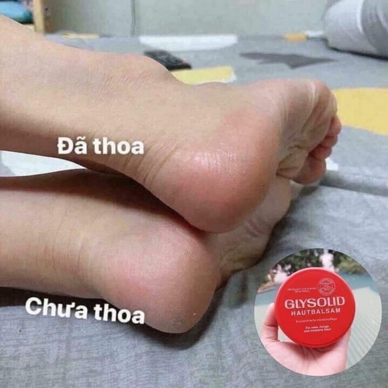 KEM DƯỠNG Glysolid Đức trị nẻ, Á sừng, nứt gót chân ...