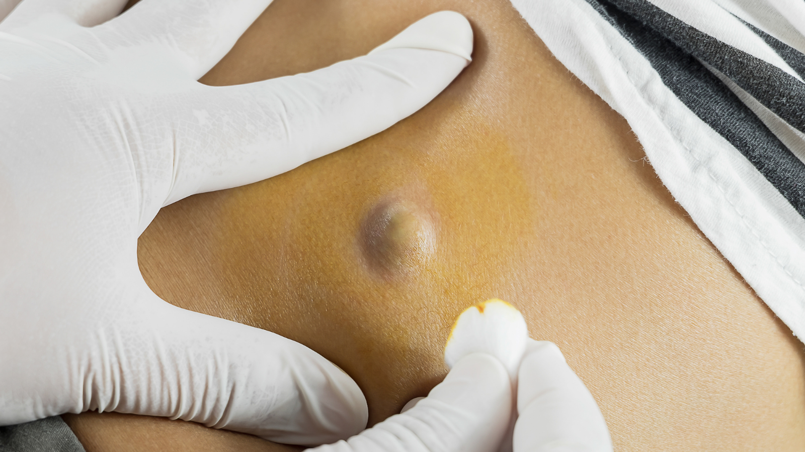 Cyst and Fistula Treatment