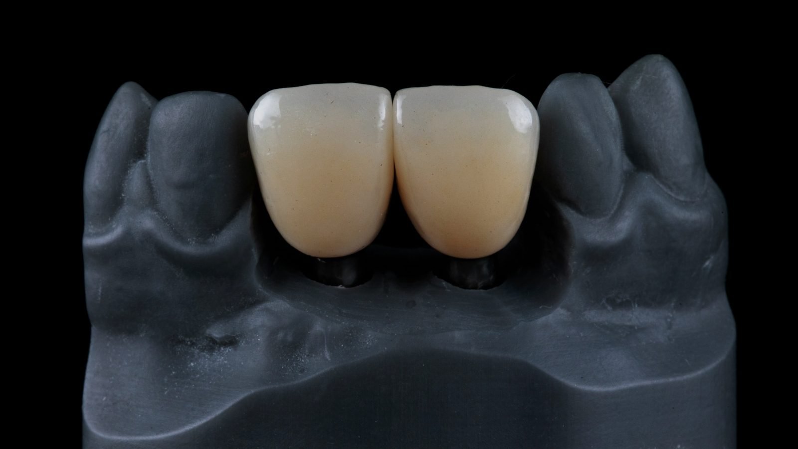 Zirconium Crown on Implant