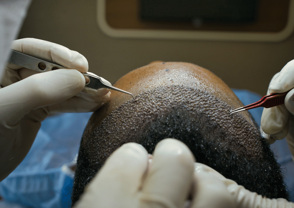 Sapphire Hair Transplant