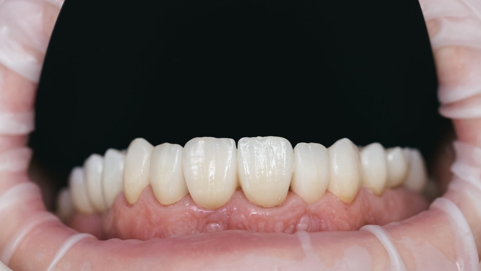 Zirconium Crown on Implant