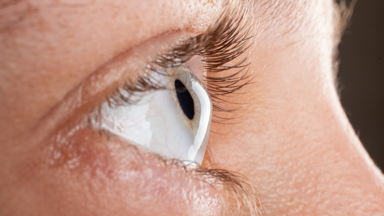 Corneal Disease