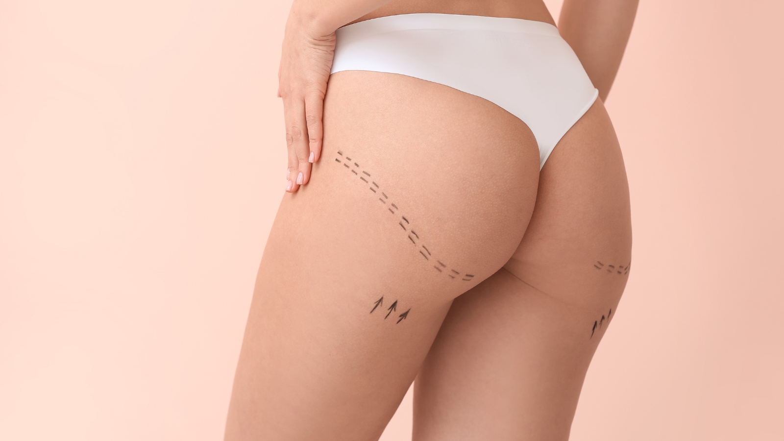 Brazilian Butt Lift - BBL