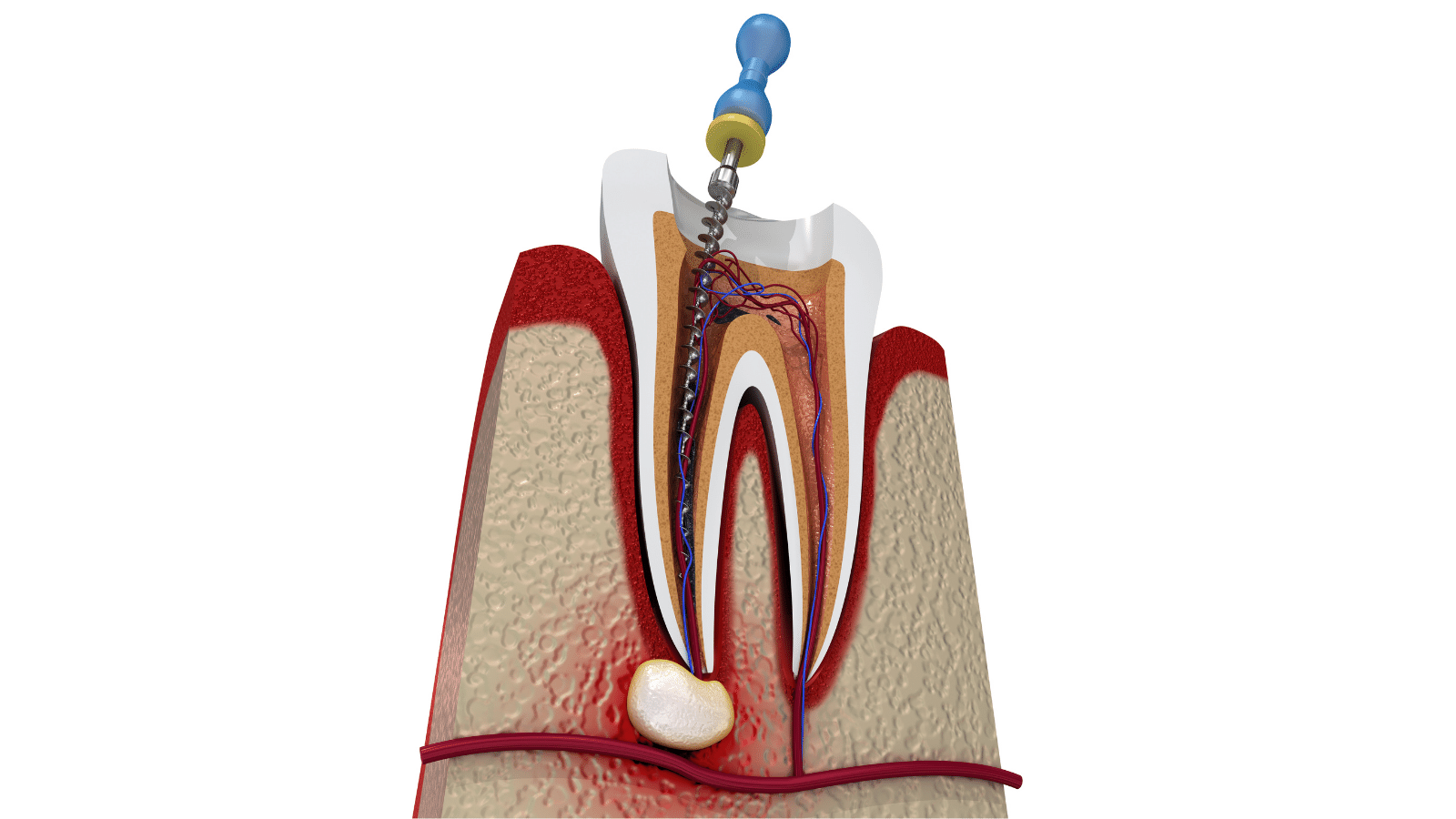 Root Canal Treatment