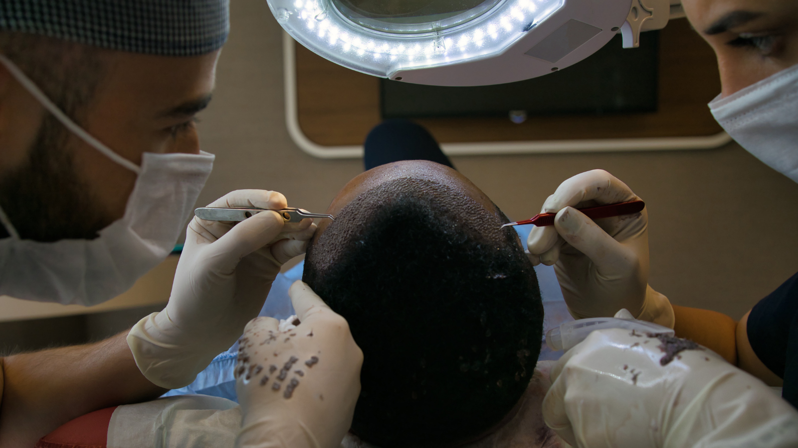 tana clinic hair transplantation