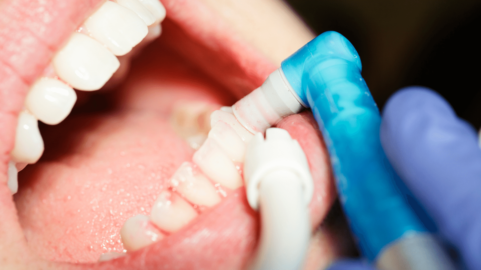 Dental Cleaning