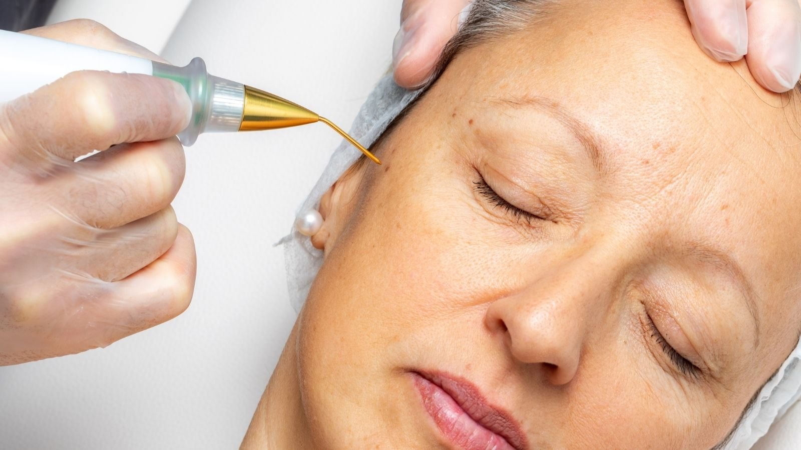 Plasma Pen for Pigmentation