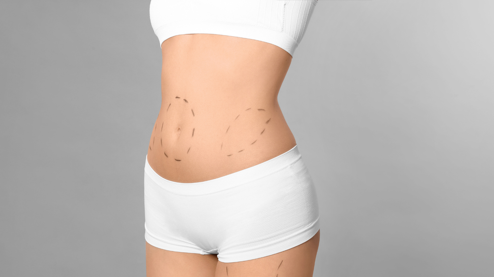 Tummy Tuck