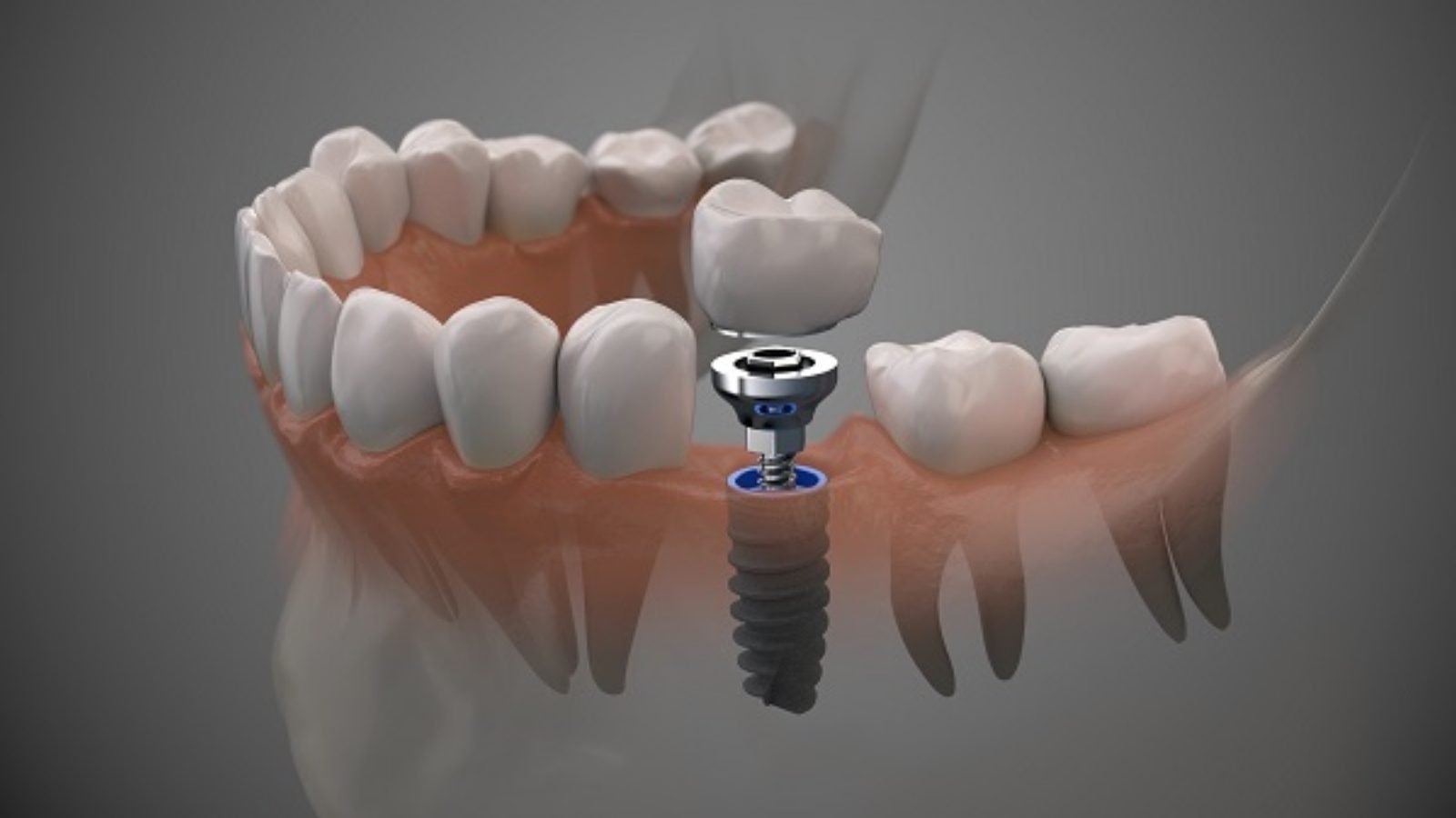 Porcelain Crown on Implant
