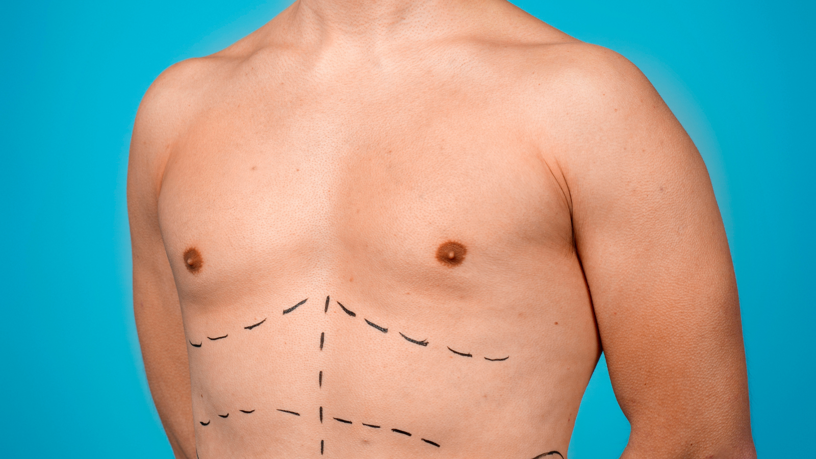 Gynecomastia