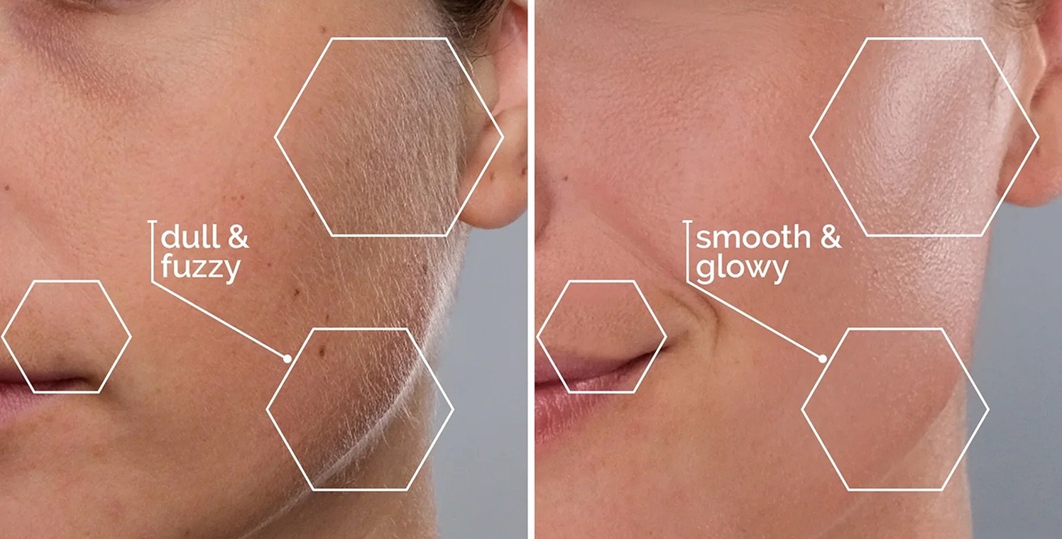 Before and after one use of SonicSmooth Pro+ — dull and fuzzy skin becomes smooth and glowy
