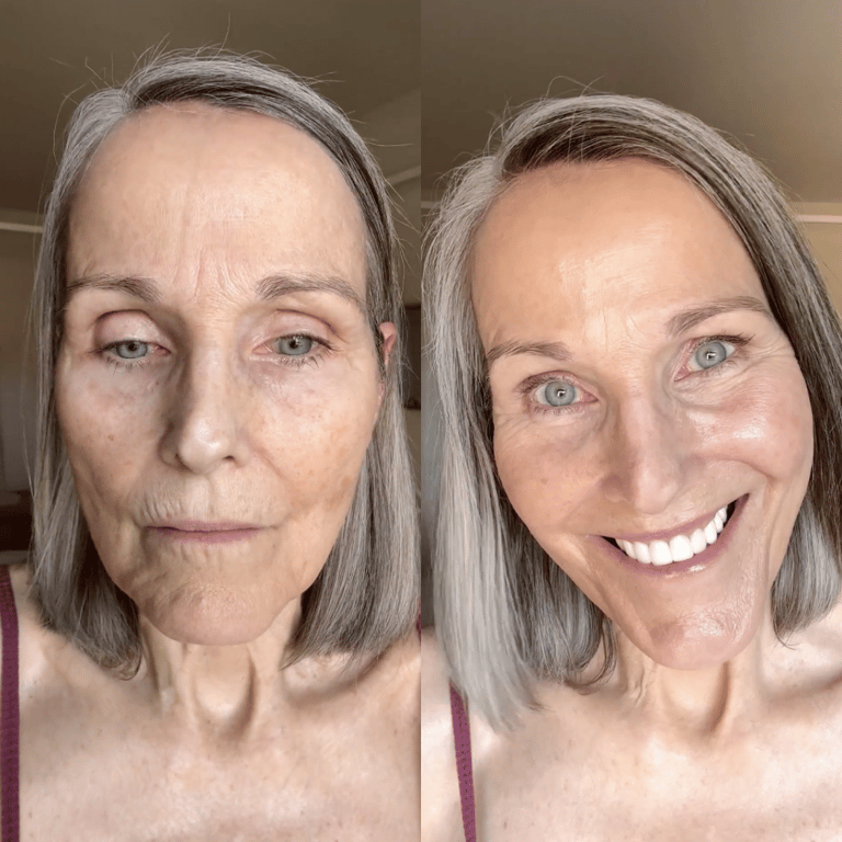 Lilian R, 60+ using the SonicSmooth Pro+
